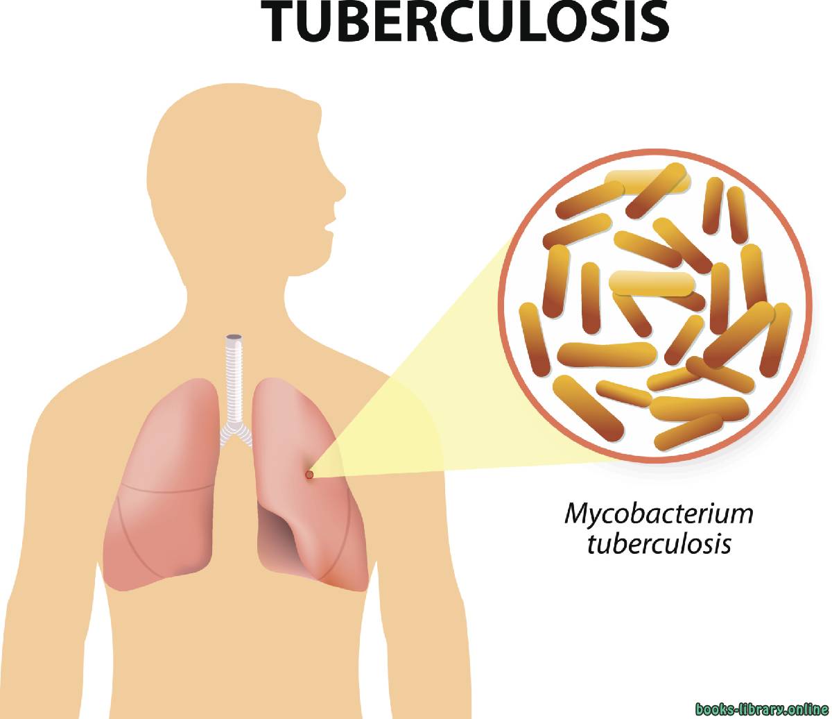 قراءة و تحميل كتابكتاب السل Tuberculosis PDF