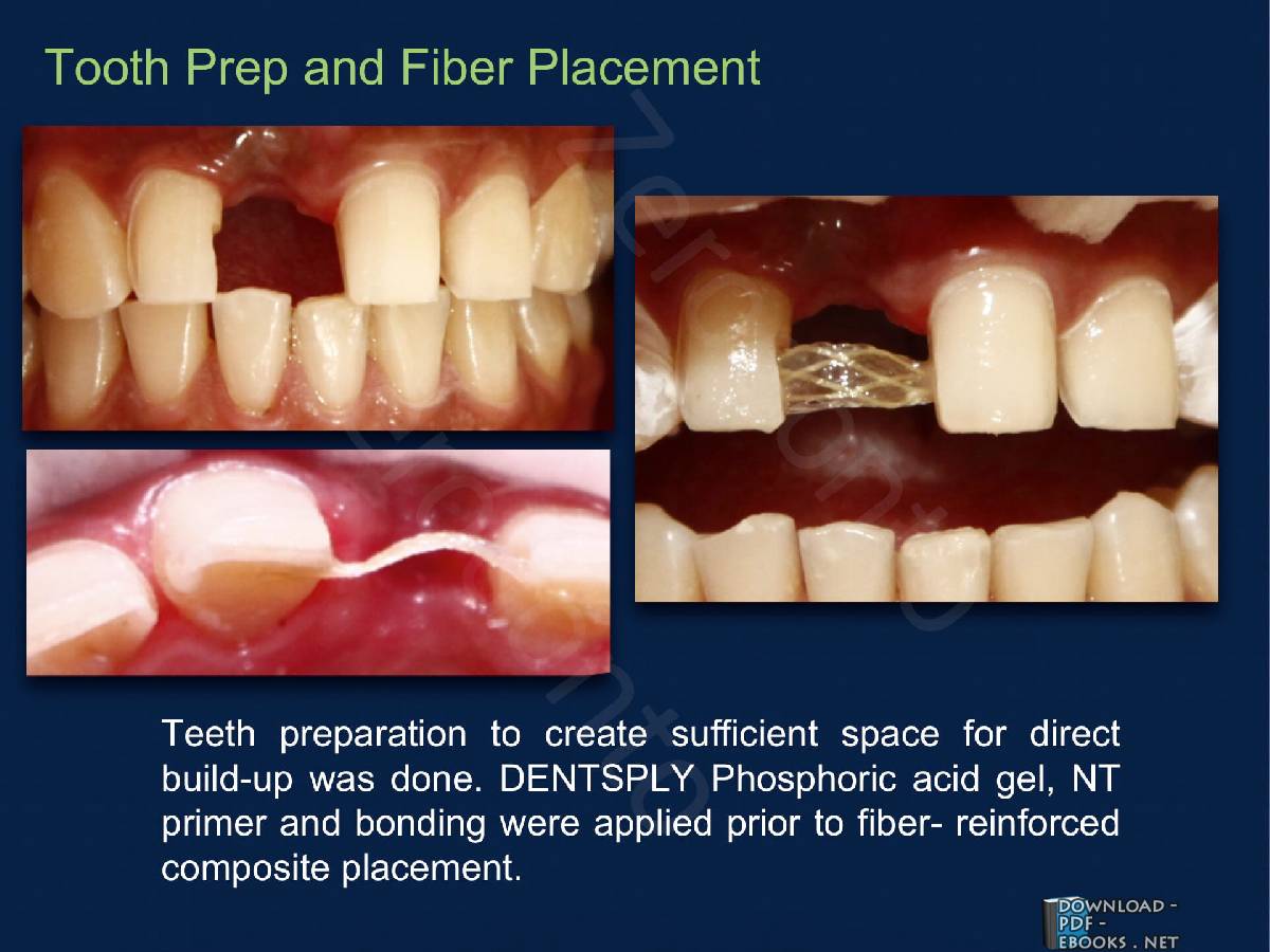 ❞ كتاب Martin A. Freilich Fiber-reinforced composites in clinical dentistry ❝ 